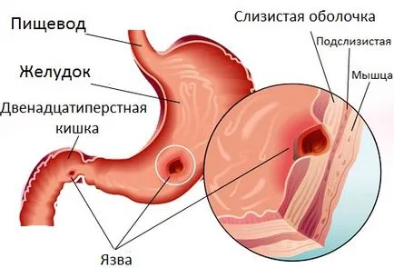 Durerea deasupra buricului - o revizuire a motivelor (partea superioară a abdomenului) Durerea deasupra buricului - o trecere în revistă a motivelor
