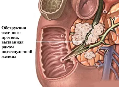 як лікувати непрохідність жовчі