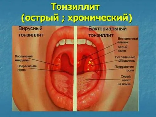 як лікувати хронічні гланди