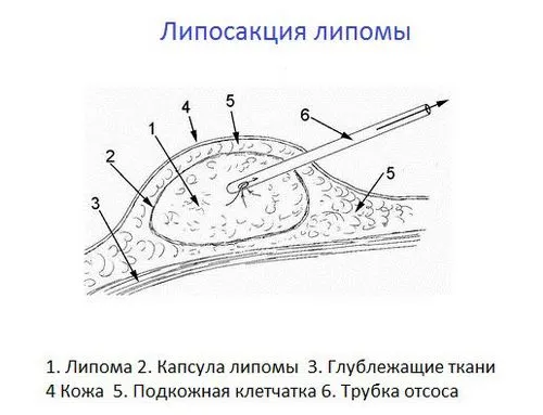як вилікувати жировик у дитини