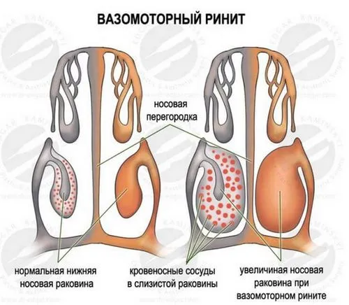 закладеність носа