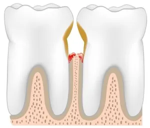 Ce se întâmplă dacă se clatină dinții cum de a consolida și de a salva molarii si lactate, intarirea gingiilor (dintilor) Ce se întâmplă dacă se clatină dinții cum de a consolida și de a salva molarii și produse lactate, întărirea gingiilor