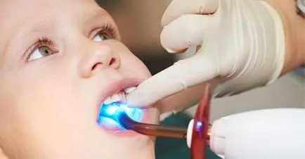 Ce este sigilarea dintilor de etanșare dentare la copii