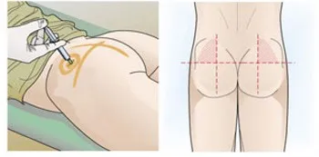 Cum de a pune injecție intramusculară în sine fese la domiciliu
