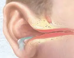 Puroi în cauze ale urechii, tratament, diagnostic (tratament) Puroi în cauze ale urechii, tratament, diagnostic