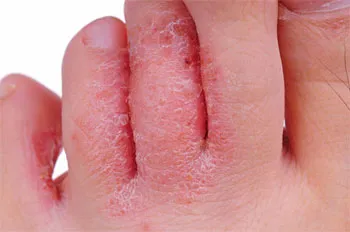 Fungus - Simptome, cauze, tratament, prevenire