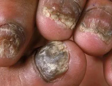 Fungus - Simptome, cauze, tratament, prevenire