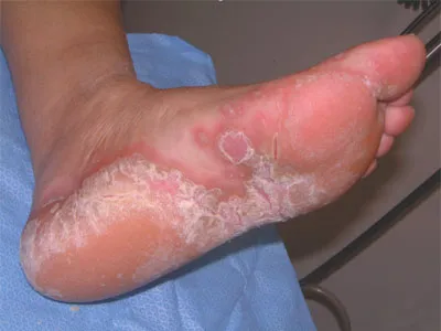 Fungus - Simptome, cauze, tratament, prevenire