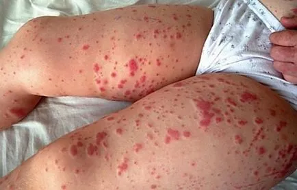 Purpura - fotografii ale copiilor, pe picioare, fata, fese, cauze, vasculită