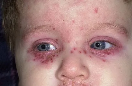 Purpura - fotografii ale copiilor, pe picioare, fata, fese, cauze, vasculită