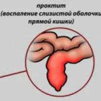 Cum sa scapi de eructatii metode populare de aer la adulți