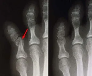 Cum de a determina fractura tep tipuri, simptome, diagnostic (picior) Cum de a determina tipurile de fractură deget de la picior, simptome, diagnostic