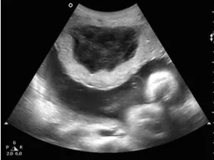 Hely a méhlepény elülső fala a terhesség lefolyására és a lehetséges kockázatok (placenta) Hely a méhlepény elülső fala a terhesség lefolyására és a lehetséges kockázatok