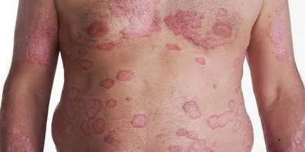 Psoriasis a kezét - kezelés korai szakaszában, a tünetek és a betegség okait (kéz) Psoriasis a kezét - kezelés korai szakaszában, a tünetek és a betegség okai