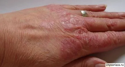 Psoriasis a kezében a fotó, színpadi, kezelése és okai