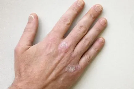 Psoriasis a kezében a fotó, a tünetek és a hatékony kezelés kenőcsök (fotó) Psoriasis a kezében a fotó, a tünetek és a hatékony kezelés kenőcsök