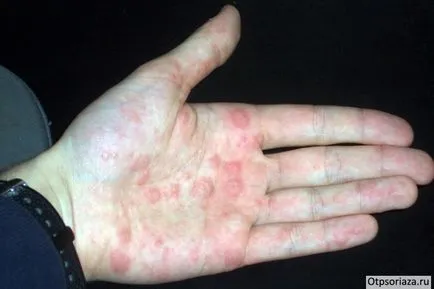 Psoriasis a kezében a fotó, színpadi, kezelése és okai