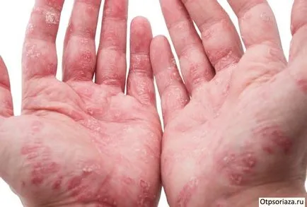 Psoriasis a kezében a fotó, színpadi, kezelése és okai