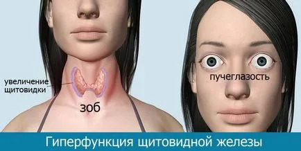 Tünetei pajzsmirigy emberekben, pro shchitovidku (pajzsmirigy-túlműködés) Tünetei pajzsmirigy emberekben, pro shchitovidku