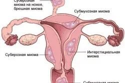 nőgyógyászat onkológia