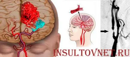 Halál eredményeképpen a stroke - valóság vagy spekulációk