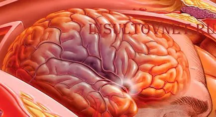 Halál eredményeképpen a stroke - valóság vagy spekulációk