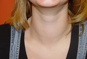 Megnagyobbodott pajzsmirigy, hogy ez Megnagyobbodott pajzsmirigy, hogy ez