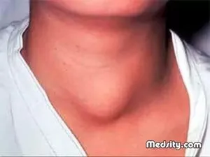 Megnagyobbodott pajzsmirigy, hogy ez Megnagyobbodott pajzsmirigy, hogy ez