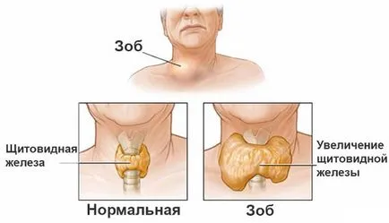 Megnagyobbodott pajzsmirigy, hogy ez