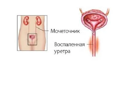 Mi húgycsőgyulladás és tünetei Mi húgycsőgyulladás és tünetei