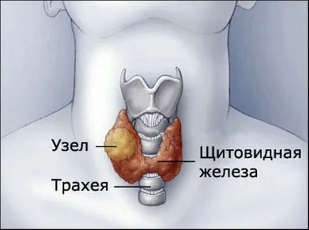 Megnagyobbodott pajzsmirigy, hogy ez