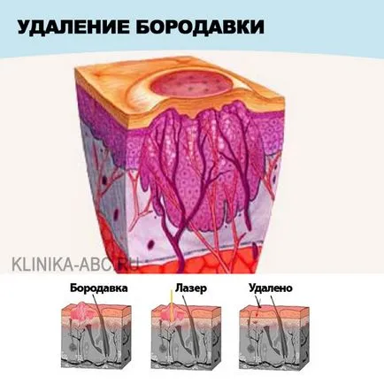 szemölcsök klinika szemölcsök klinika