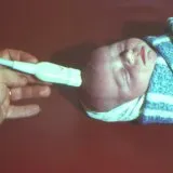 Az intracranialis nyomás csecsemőkben kezelt