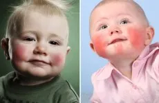 Az intracranialis nyomás csecsemőkben kezelt
