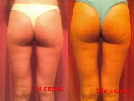 Anti-cellulit masszázs krém Vitex vélemények Anti-cellulit masszázs krém Vitex vélemények