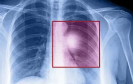 Tüdőadenocarcinoma tünetek, színpad és prognózisa az élet (élet) Adenocarcinoma a tüdő tünetek, színpadi és prognózis az élet