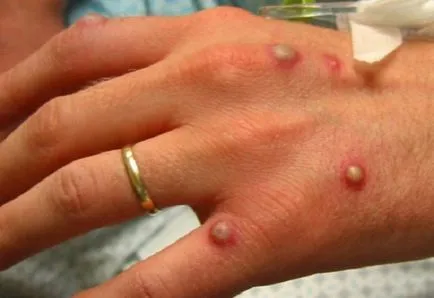 Allergia a kezét a buborékok formájában - Kezelés és (buborékok) Allergia kéznél a buborékok formájában - kezelés és