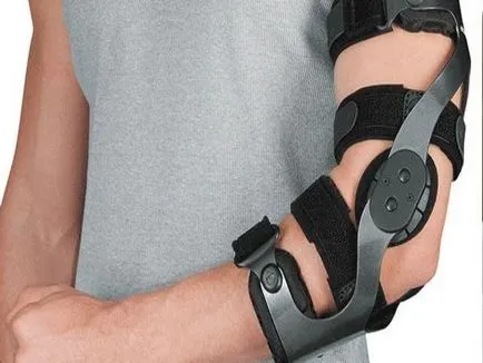 könyökízület arthrosis kezelésében emberek jogorvoslatok