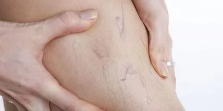 Fájdalom visszeres - hogyan enyhíti a fájdalmat a vénákban, orvosi helyén (fájdalom) Fájdalom visszeres - hogyan enyhíti a fájdalmat a vénákban, az orvosi oldalon