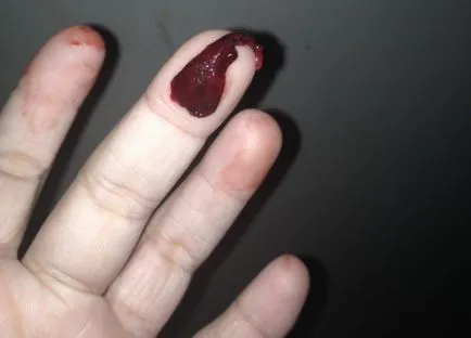 Hurts petefészek ciszta