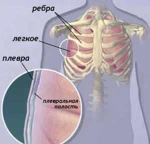 Mi ez - mellhártya rétegek röntgenfelvételen a tüdőben, és úgy néz ki, mint egy egészséges tüdő