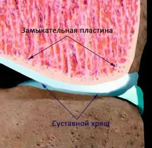 Mi ez a porc melletti sclerosis ízületi felületek és a véglapok a csigolyatestek (porc melletti sclerosis véglapjainak a csigolyák) Mi van a porc melletti szklerózis, az ízületi felületek és a véglapok a csigolyatestek