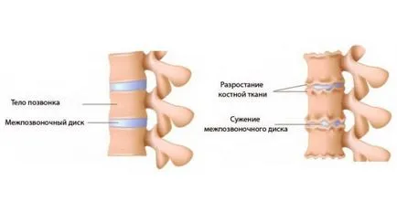 Mi chondrosis betegség tünetei és kezelési módszerek (tünetek) Mi chondrosis betegség tünetei és kezelési módszerek