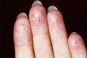 Disgidroticheskaya okoz ekcéma, kenőcsök, népi jogorvoslati kezelés (ellentétben disgidroticheskoy ekcéma Palmar plantáris psoriasis) Disgidroticheskaya okozza ekcéma, kenőcsök, kezelése népi jogorvoslati