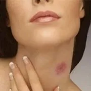 Álomértelmezés szívva a nyaka, hogy az álom, amit az álmok (álmok, álom értelmezés nyak Hickey férfi álma egy kolléga) Álomértelmezés szívva a nyaka, hogy az álom, mi álmok