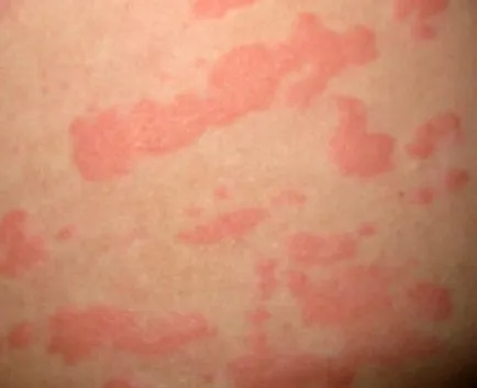 Solar allergia kezelésére, megelőzésére, bőrtünetek (antihisztamin szemcsepp) Solar allergia kezelésére, megelőzésére, bőrtünetek