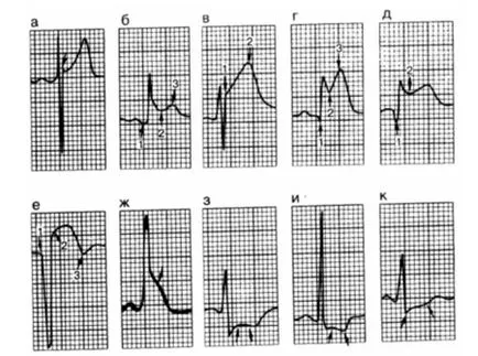 Fireaid elektrokardiográfiás - EKG (pitvari patológia (p) és kamrai (QRS, st)