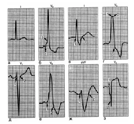 Fireaid elektrokardiográfiás - EKG (pitvari patológia (p) és kamrai (QRS, st)