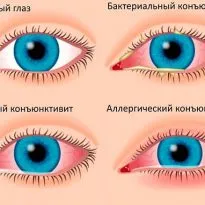 Szemcsepp származó konjuktivita felülvizsgálat készítmények (csepp) Szemcsepp származó kötőhártya felülvizsgálat készítmények