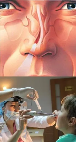Eltért septum - okai, típusai, tünetei, hatásai, kezelések (faj) Eltért septum - okai, típusai, tünetei, hatásai, kezelések